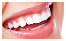 veneers